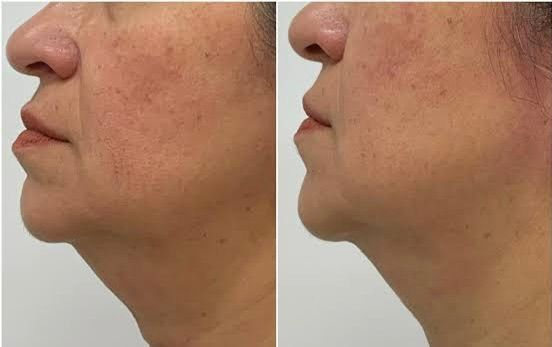 Antes e Depois - Efeito lifting